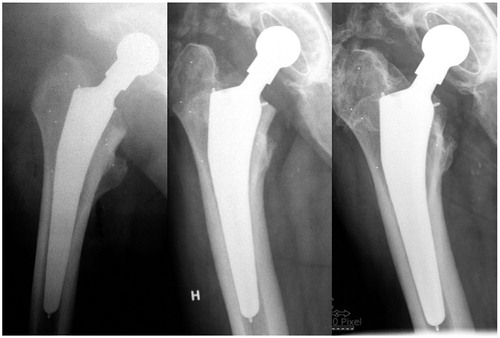 Figure 2. The postoperative, 3-month and 5-year radiographs from the patient that was excluded from RSA analysis. The stem seems to be undersized in the postoperative image. There is macroscopic subsidence from postoperatively to 3 months, but no visible changes thereafter, consistent with the RSA data.