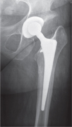 Figure 7. Anteroposterior radiograph of the left hip in a 44-year-old woman with CDH at 12 years after THA.
