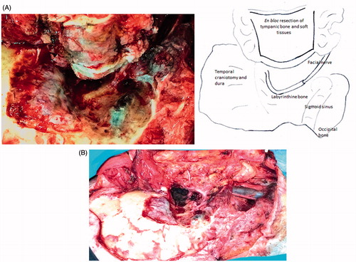 Figure 1. Right LTBR inT2 tumor (surgical picture); (A) posterior view on the resected tympanic bone and temporal craniotomy; (B) the cranial surgical field after neck dissection and parotidectomy. Following removal of the specimen, the facial nerve is seen from the second genu to the periphery.