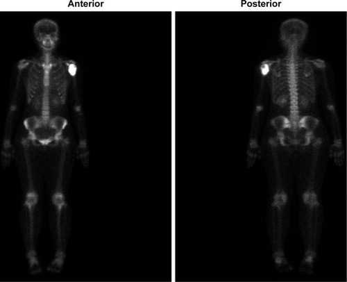 Figure 3 Bone scan showed the lesion had nuclear tracer uptake.