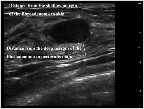 Figure 1. Measurement of the distance from the shallow margin of the fibroadenoma to the skin and the distance from the deep margin of the fibroadenoma to the pectoralis major.