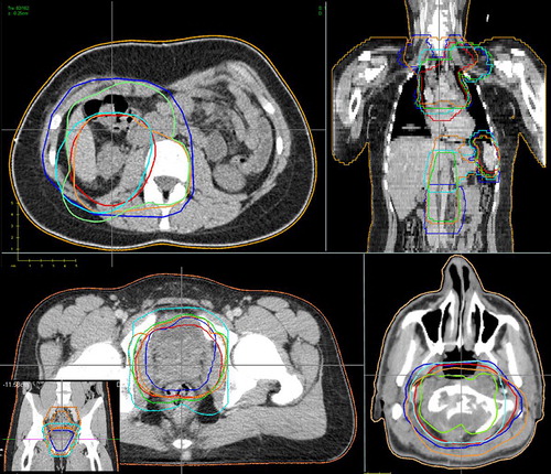 Figure 1. Representative CT images with PTV delineation for the four patient cases and the five centres. Upper left: Case 1 – Wilms’ tumour. Upper right: Case 2 – Hodgkin’s disease. Lower left: Case 3 – rhabdomyosarcoma. Lower right: Case 4 – chordoma.
