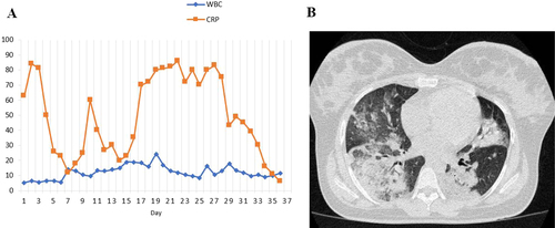 Fig. 1 A The leukocyte (103/uL) and CRP (mg/dl) trend chart of the patient. B Chest computed tomography scan showing bilateral ground-glass opacity