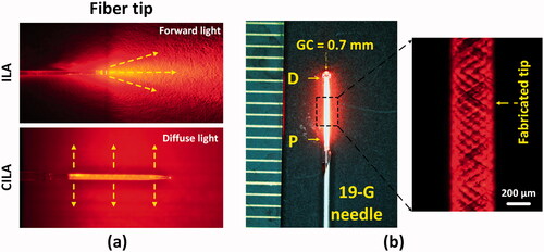 Figure 1. Cylindrical interstitial laser ablation (CILA) of pancreatic tissue: (a) comparison light emission between interstitial laser ablation (ILA: forward emission) and CILA (diffuse emission), and (b) image of diffusing applicator (DA) with uniform He-Ne light distribution through 19-G biopsy needle (GC: glass cap, P and D = proximal and distal ends of DA).