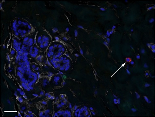 Figure 5 CD24+ cells in TDLU stroma.