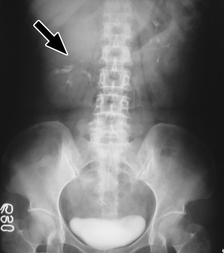 Figure 2. Intravenous pyelography of case 13. A huge soft-tissue mass (arrow) in the upper pole of the right kidney with stretching of calyces.