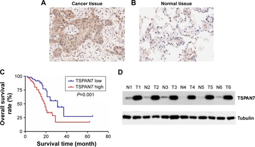 Figure 1 High level of TSPAN7 expression associates with clinicopathological factors and poor prognosis in non-small-cell lung cancer patients.