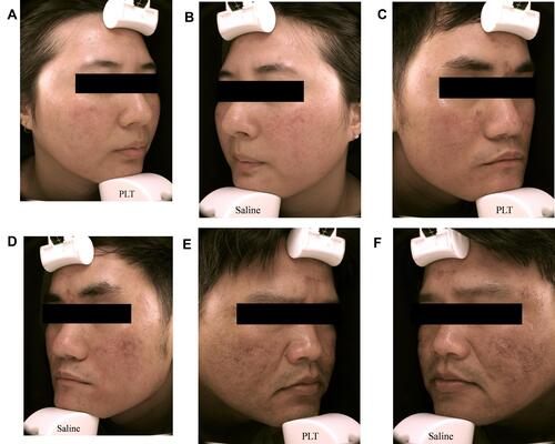 Figure 1 Face images of fractional carbon dioxide laser treatment after 2 days. The Platelet-lyophilized treatment (PLT)-treated side shows fewer scars.