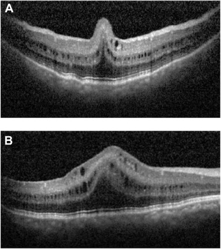 Figure 1 SD-OCT of the macula in the right eye at presentation.