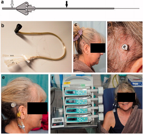 Figure 2. A CED catheter system incorporating an external guide tube (black arrow) and 0.6-mm OD carbothane catheter (white arrow) was implanted (a). The catheters were attached to a transcutaneous bone-anchored port assembly (b). The transcutaneous port was implanted using a skin-flap dermatome technique behind the right ear (c and d). Infusions were performed by attaching a needle administration set incorporating in-line gas and bacterial filters to the port using MRI-compatible pumps (e and f).