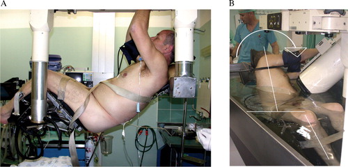 Figure 1. (A) Patient strapped to the flexible stretcher prior to positioning inside the HM3 water bath. (B) Physically demanding flexing and twisting positioning for the treatment of left ureteral calculi in order to open a clear path for shock waves.