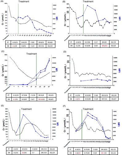 Figure 3. Relationship of DSA MFI and AR occurrence and reverse. (A–F) Case 1 to 6 with DSA-positive. Black line: the Creatinine dynamic changes of recipients post-operative. Blue line: the DSA MFI dynamic changes of recipients post-operative. Green line: The time of treatment. The below form described the HLA matching of patient (PT) and donor (DN). Red words: HLA locus which induced DSA.