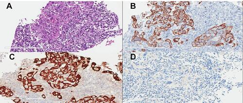 Figure 2 Histologic features of the tumor. (A) The tumor consisted of poorly differentiated cells with major lymphocytic infiltrates (hematoxylin-eosin staining (HE), 200×). Immunohistochemically, the neoplastic cells showed (B) cytokeratin 19 (HE, 200×) and (C) cytokeratin 7 (HE, 200×) expression and (D) no HepPar-1 expression (200×).