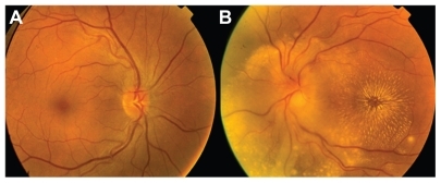 Figure 1 Color fundus photograph (A) right eye: normal appearance of the fundus; (B) left eye: showing edema of optic disc with some retinal infiltrates and exudates encircling the fovea in a shape similar to a star.