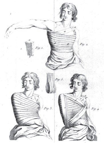 Figure 10. Desault’s three-layer bandage recommended for immobilisation of fractures of the clavicle and the proximal humerus. The bandage was also used for immobilisation of glenohumeral dislocations. Reprinted from Desault (Citation1805) 95.