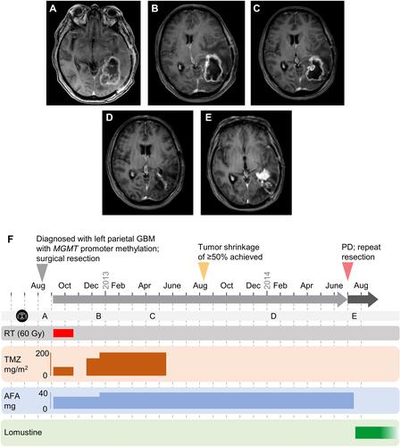 Figure 2 Radiological Disease Assessment in Patient 2. (A) August 2012: Scan taken at entry (baseline) for trial 1200.38, following surgical resection in the same month. From September 2012, the patient received 6 weeks of treatment with afatinib (30 mg QD) with RT (60 Gy in 30 fractions over 6 weeks) and TMZ (75 mg/m2 QD), then four weeks with afatinib (30 mg QD) monotherapy. (B) December 2012: patient imaged during Cycle 1 of 6 of treatment with afatinib (30–40 mg QD) with TMZ (150–200 mg/m2 on Days 1–5 of each 28 day cycle). (C) April 2013 (Cycle 5). Following Cycle 6, the patient received afatinib 40 mg QD monotherapy from May 2013. Patient achieved tumor shrinkage ≥ 50% in August 2013. (D) January 2014 (Cycle 15). (E) July 2014 (Cycle 21): after 22 months of benefit from afatinib, the patient experienced recurrence. Subsequently, the patient underwent repeat resection and commenced post-operative treatment with lomustine (CCNU). (F) Timeline of treatment and response. Horizontal gray arrows represent time on treatment before disease progression. The dates of the scans shown in panels (A-E) are illustrated on the light gray horizontal bar (with black, circular scan icon).