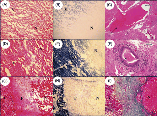 Figure 4. Histological examination of the immediately resected liver (A and B: rat; C-F: rabbit) and the remnant liver after a 30-day recovery (G-I: rabbit). The livers immediately after the resection showed coagulation necrosis with loss of NADPH-diaphorase activity in necrotic area (N) compared to viable liver tissue (V) (A, B, D and E). After the thermocoagulation, the lumen of blood vessel was blocked by thrombus (C, arrow) and the lumen of bile duct was blocked by condensed plugs (F, arrow). After a 30-day recovery, the resected margin of remnant liver showed a fibrous band (F) between viable liver tissue (V) and necrotic tissue (N) indicating a healing process (G-I). (A, D and G: H & E stain, 100×; C: H & E stain, 40×; F: H & E stain, 200×; B, E and H: NADPH-diaphorase stain, 100×; I: Masson-trichrome stain, 100×).