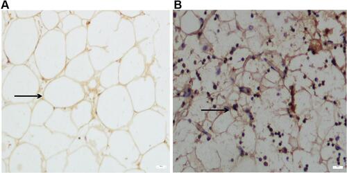 Figure 1 Immunostaining images of UCP-1 expression in adipose tissue derived from obese (OB) (A) and normal weight (NW) group (B). Black arrows suggest the adipocyte size and morphology. Scale bar: 50 μm.