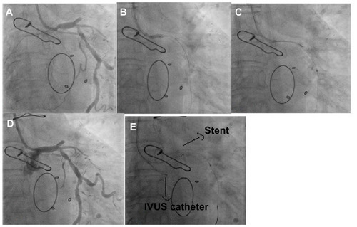 Figure 13 Inadequate support provided by a Judkins left guide catheter for an IVUS catheter post stenting of a left main artery.