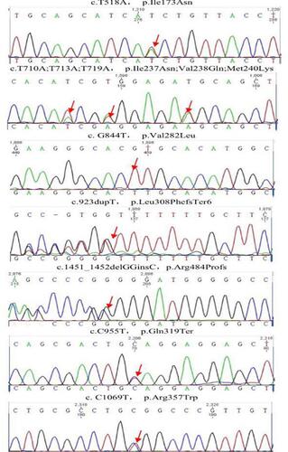 Figure 2 Proband gene sequencing: the red arrows indicate the sites of genetic mutation.