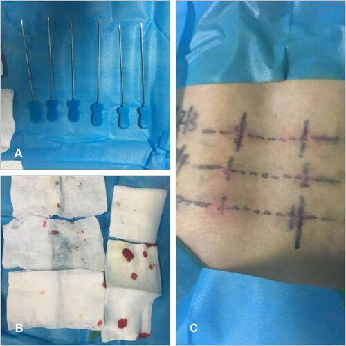 Figure 4 (A) The needle-knife used in the surgery; (B) intraoperative blood loss; (C) postoperative body-surface situation.