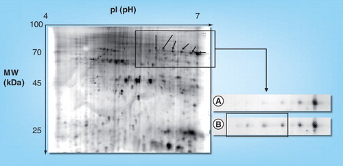 Figure 2. Autoantigen detection in rheumatology by 2D-immunoblotting of synovial tissue proteins.Total 2D image of synovial tissue protein extract (12.5% Laemmeli, pH 4–7, silver staining) (left). Reincubation of 2D-blots with rheumatoid arthritis serum (B) of membranes previously probed with control serum (A). New immunoreactive spots appear at the acidic side of the spot train (right).Reproduced with permission from Whiley-VCH Verlag GmbH & Co. KGaA: Proteomics – Clinical Application, © 2007 Citation[20].