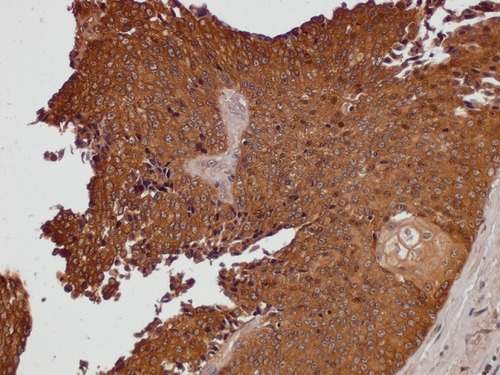 Figure 1 Bladder carcinoma, papillary (TCPC) (HBlaU066Su01, position A8) (77-year-old male, grade II, T1-M0, malignant bladder cancer) probed anti-TM, counterstained with hematoxylin (magnification 200x).