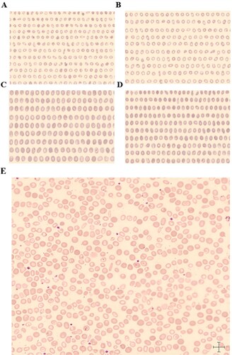 Figure 1. AB. The scanning image of microcytic cells (A) and normocytes (B) in a sample of microcytic hypochromic anemia. CD. The scanning image of macrocytic cells and normocytes in a sample of macrocytic anemia. (E) Two kinds of red blood cells can be seen in the RBC overview image. The sample is microcytic hypochromic anemia after treatment. Target red blood cells can be seen in this picture.