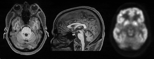 Figure 1. T1-weighted MRI at age 49. Cerebellar atrophy is appreciable in the axial (left) and midline sagittal plane (middle). FDG-PET scan revealed cerebellar hypometabolism.