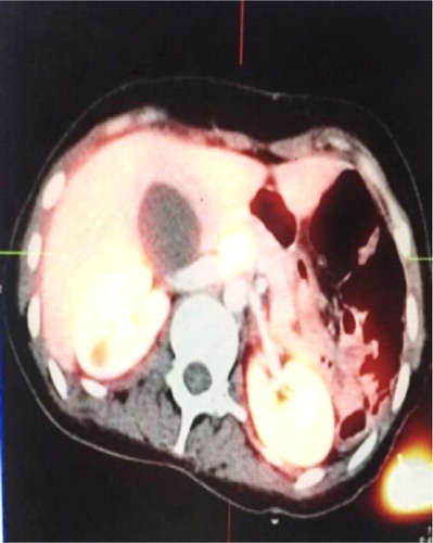 Figure 2: Enlarged Ga-DOTA octreotate PET/CT showing avid active disease in the pancreas.