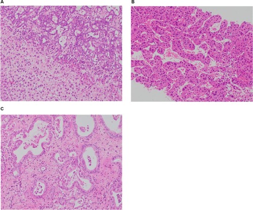 Figure 1 (A) Combined hepatocellular and cholangiocellular carcinoma. A single tumor nodule shows two different histological components, one with glandular differentiation and biliary immunoprofile consistent with cholangiocarcinoma (upper area of the picture) and one with a well-to-moderately differentiated hepatocellular carcinoma (lower part of the picture); H&E staining. (B) Moderately differentiated HCC, trabecular pattern. Cellular variability with scattered large hyperchromatic nuclei; H&E staining, 100×. (C) Moderately differentiated intrahepatic cholangiocarcinoma. Glandular structures are variable in size and shape, in a sclerosed stroma; H&E staining, 100×.
