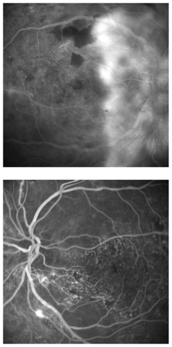 Figure 4 Fundus photograph of fluorescein angiography. Massive dye leakage from the disc neovascularization can be seen in the right eye. The neovascularization is surrounded by preretinal hemorrhage (Top). No obvious dye leakage, except for a slight leakage of the inferior artery, is seen in the left eye. A vascular bed occlusion is apparent inside of the arcade vessels (Bottom).