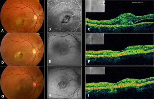 Figure 3 Right eye of patient 5. Color photo A) shows angioid streaks and subfoveal hemorrhages. Fluorescein angiography B) demonstrates the presence of choroidal neovascularization (CNV), and optical coherence tomography (OCT) C) reveals the neovascular complex as a high-reflective, red-yellow band in the subretinal space above the RPE/choriocapillaris layer, causing intra e subretinal exudation. Best-corrected visual acuity 20/400 [1.3 LogMAR]). Three months after PDT/IVTA: color photo D), fundus autofluorescence E), and OCT F) demonstrate restoration of foveal anatomy. Best-corrected visual acuity improved to 20/80 (0.6 LogMAR). One year after PDT/IVTA: color photo G), fundus autofluorescence H), and OCT I) show involution of CNV surrounded by some atrophic changes, and absence of blood and subretinal fluid. Best-corrected visual acuity was 20/50 (0.4 LogMAR).