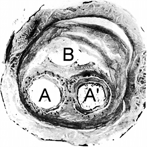 Figure 5 Histology of the cross section slightly upstream of Figure 4. The stents of the bifurcation of the short limb of the device and the one of the ipsilateral limb are superposed, resulting in the compression of the polyester tube, which loses its cylindrical characteristics (A). On the opposite, the polyester tube preserves its cylindrical shape (A′). The content of the aneurysmal sac has solidified; however, a small canal is still visible (B). The fibrous tissues are almost acellular and the wall of the artery is stretched but mostly keeps its continuity. There are, however, some disruptions.