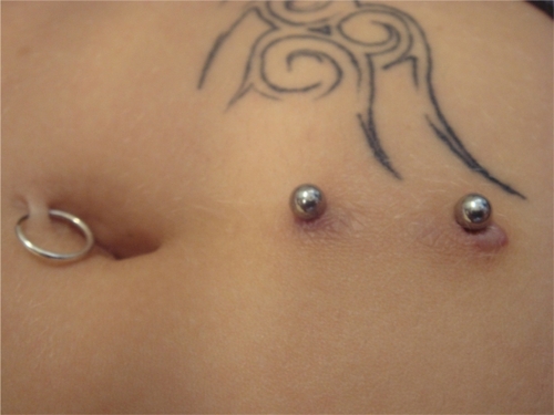 Figure 5 Piercing, tunnelling and tattoo in a 24-year-old female. Skin inflammation tunnelling site.