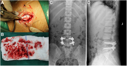 Figure 2 Intraoperatively, patients were treated with streptomycin to treat infection (A). Surgical specimens (B). Postoperative plain radiographs showed that the L4/5 vertebral space height was restored and the internal fixation was firm (C and D).