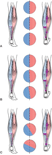 Figure 2. Artist’s impression of the triple-hemisection Achilles tendon lengthening with cross sections. A. 0° torsion (theoretical situation). The tendon fibers are parallel. 3 hemisections will sever neighboring fibers and the fiber bundles will glide along each other. B. 11° torsion. The tendon fibers are still almost parallel and the fibers will still glide along each other after 3 hemisections. C. 65° torsion. The 3 hemisections do not sever neighboring fibers, and the gliding mechanism will fail or remain incomplete.