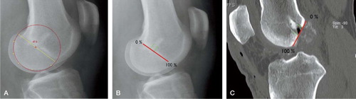 Figure 3. A. Lateral view of the lateral femoral condyle by the method of Amis (Amis et al. Citation1994). The yellow dots are the user-defined edges of the posterior femoral condyle. A circle is automatically fitted on to the dots and can be rotated, in such a way that the diameter is parallel to Blumensaat's line. B. Lateral view of the lateral femoral condyle by the method of Aglietti (Aglietti et al., Citation1995). These authors compare the tunnel measurement to a line parallel to the most posterior and anterior part of Blumensaat's line. C. Measurement according to Aglietti on the sagittal femoral CT reconstruction.