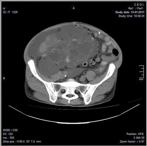 Figure 2.  CT scan of the pelvis performed after the appearance of ascites; note the massive right kidney pulling the gut to the left and the peritoneal dialysis catheter in the upper right.
