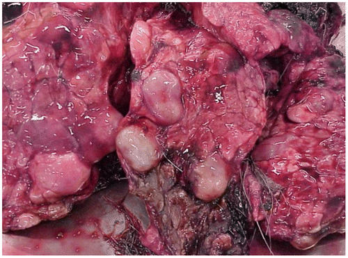 Figure 2. Lung infected by hydatic cyst.