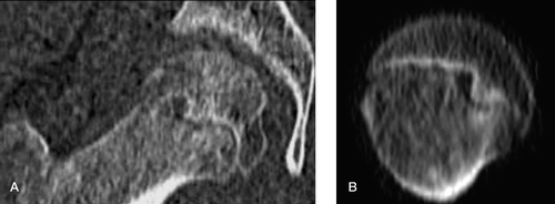 Figure 3. AP (A) and axial (B) CT scanograms of the right hip of the 13-year-old boy whose radiograph is shown in Figure 1A, now revealing an epiphyseal peg that seems to be a rather loose fit in the metaphyseal socket.