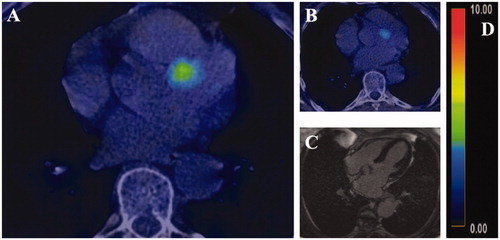 Figure 2. Initial FDG-PET-CT showed a focal uptake of radiotracer-marked glucose at the baseline (A) and at the follow-up (B). No findings were detected on cardiac magnetic resonance imaging (axial view image, (C). The SUVmax values were 5.4 and 3.4 at the baseline and the follow-up imaging, respectively (relative uptake color coding, (D)).