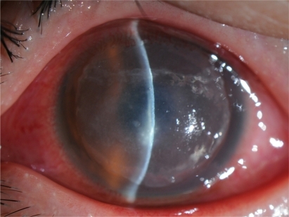 Figure 1 Slit-lamp examination shows marked presence of stromal infiltrates involving the flap and the underlying stroma.