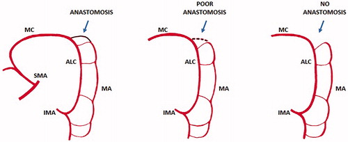 Figure 13. John Daniel Griffiths (1926–2001) was a leading cancer surgeon and senior consultant both at Barts and Royal Marsden hospitals in London. In the late 1940s Griffiths carried out research into the blood supply of the colon and circulating cancer cells at the time he spent two years as an anatomy demonstrator under A J E Cave, before becoming registrar and starting his surgical education and training. The Griffiths’ point (or Griffiths’ critical point) refers to the site of watershed anastomosis between the ascending left colic artery and the marginal artery of Drummond occurring in the region of the splenic flexure: the anastomosis may be substantial, tenuous or absent. SMA: superior mesenteric artery; IMA: inferior mesenteric artery; MC: mid colic artery; ALC: ascending left colic artery; MA: marginal artery (modified from Meyers MA).