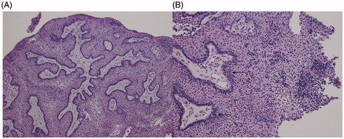 Figure 2. Histopathological imaging confirms a papillary squamous craniopharyngioma. (A) Low power (25×) microscopy image depicting the tumor’s largely papillary architecture and solid appearance. Calcifications and wet keratinization were noted to be absent. (B) Higher power (50×) image of the papillary squamous craniopharyngioma (WHO Grade I) depicting squamoid cells and tall, dark palisading nuclei (black arrows). The tumor is solid in appearance and does not show calcifications.