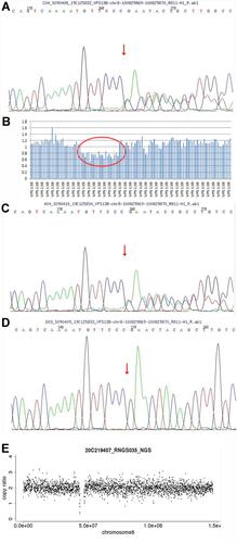 Figure 3 Results of the whole-exome sequencing of the VPS13B gene in the pedigree of the present case. (A) The heterozygous mutation c.8275 delC in exon 45 of the child. (B) The heterozygous deletion in exon 20–32 of the child. (C) The heterozygous mutation c.8275 delC in exon 45 of the mother. (D) The heterozygous mutation c.8275 delC in exon 45 absent in the father. (E) The heterozygous deletion in exon 20–32 of the father.