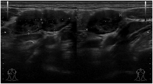 Figure 2. Echography of bilateral submandibular lymph nodes. Note their spherical form and the absence of hila.