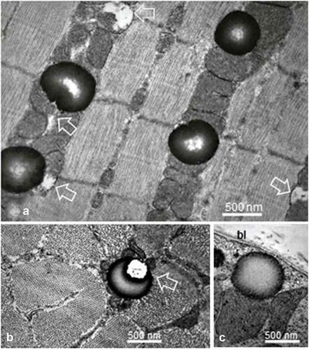 Figure 4. a-c: Enlarged spherical lipid deposits (SDs) located in intermyofibrillar location found in all SO or FOG fibers, among the rows of adjacent mitochondria as well as rare in subsarcolemmal position (c) and seldom found in FG fibers. White open arrows indicate damaged and degraded mitochondria throughout a and c. in b, a puzzling, eccentric fatty degradation between SD with mitochondrion. Note the centripetal gradient of oxido-reduced osmium contrast of all SDs. bl: basal lamina