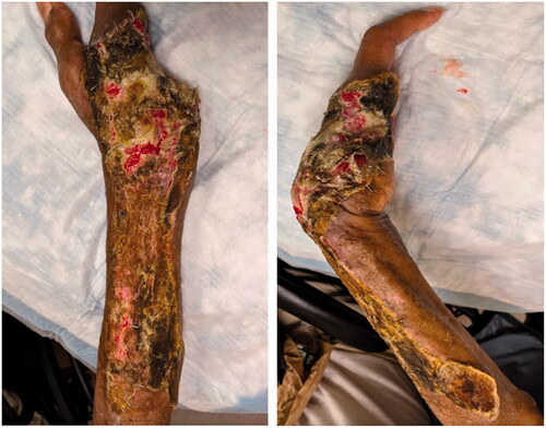 Figure 6. Two weeks after split thickness skin graft placement.