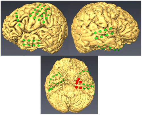 Figure 2. Layout drawing. Left, ECoG electrodes were implanted over the motor area (20) and the lateral temporal lobe (8). The 8 triangle-shaped electrodes and 2 sets of 4 electrodes were implanted over the temporal base. Right, electrodes were implanted over the front temporal lobe (8). The 8 triangle-shaped electrodes and 2 sets of 4 electrodes were implanted over the temporal base. According to ECoG, the focus located on left mesial temporal (red circle).